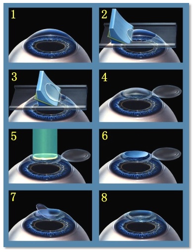 lasik-process